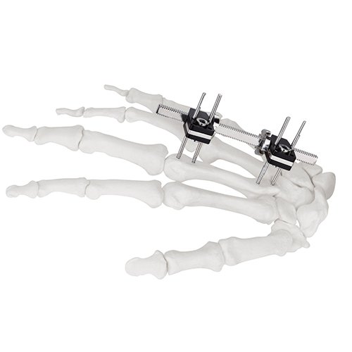 Mini Fragment External Fixator (Finger and Palm)