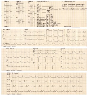 Color&Touch Screen ECG Machine ECG312T