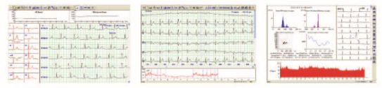 Holter ECG Monitor Heart Rec ECO