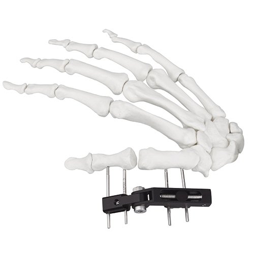 Mini Fragment External Fixator (Finger and Palm)